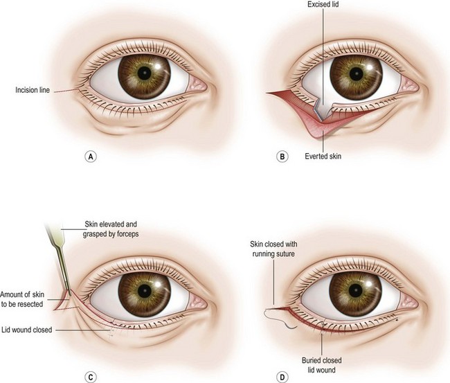 Entropion/Ectropion correction-Lateral Tarsal Sling Procedure