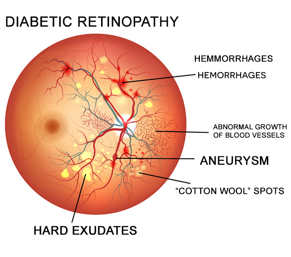 Diabetic-Retinopathy-Eye-Disease