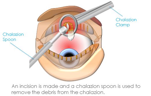 chalazion surgery