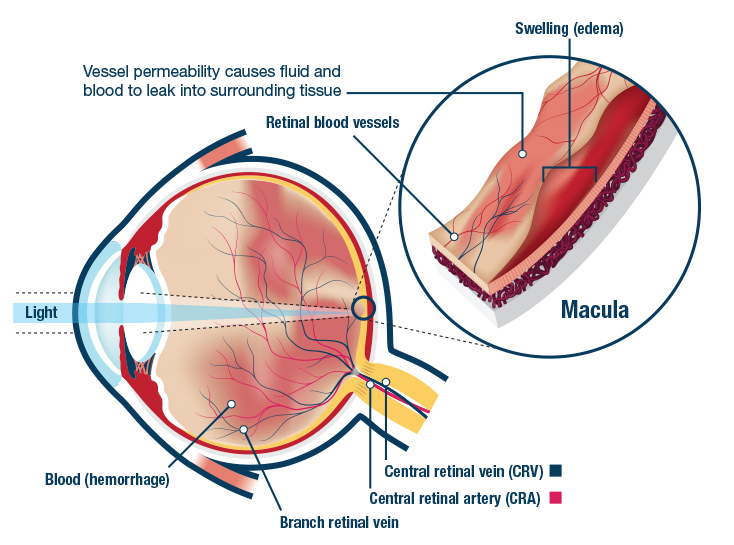 Branch Retinal Vein